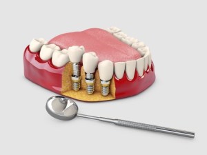 Inside look at dental implants